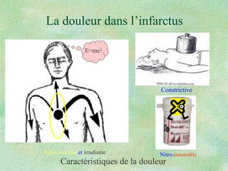 La douleur dans l’infarctus Caractéristiques de la douleur Rétro-sternale  et  irradiante Constrictive Nitro- insensible E=mc 2 