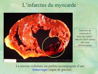 L’infarctus du myocarde La nécrose cellulaire est parfois accompagnée d’une  hémorragie  (signe de gravité) Infarctus du ventricule G avec (au centre – dans le cercle jaune) une zone hémorragique 