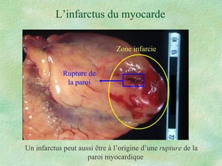 L’infarctus du myocarde Un infarctus peut aussi être à l’origine d’une  rupture  de la paroi myocardique Zone infarcie Rupture de la paroi 