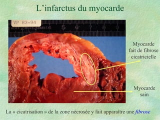 L’infarctus du myocarde La « cicatrisation » de la zone nécrosée y fait apparaître une  fibrose Myocarde sain Myocarde fait de fibrose cicatricielle 