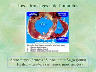 Les « trois âges » de l’infarctus Acute =  aigu  (heures) / Subacute =  subaigu  (jours) Healed =  cicatrisé  (semaines, mois, années) VG VD 