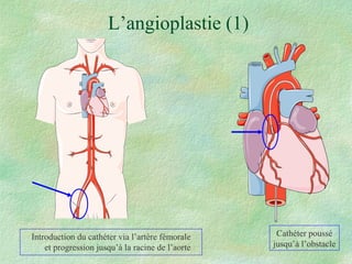 L’angioplastie (1) Introduction du cathéter via l’artère fémorale et progression jusqu’à la racine de l’aorte Cathéter poussé jusqu’à l’obstacle 