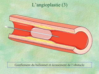 L’angioplastie (3) Gonflement du ballonnet et écrasement de l’obstacle 