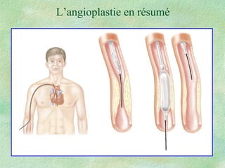L’angioplastie en résumé 