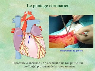 Le pontage coronarien Procédure « ancienne » : placement d’un (ou plusieurs) greffon(s) provenant de la  veine saphène Prélèvement du greffon 