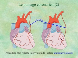 Le pontage coronarien (2) Procédure plus récente : dérivation de l’artère   mammaire interne A.M.I. 