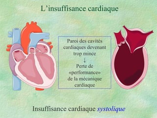 L’insuffisance cardiaque Insuffisance cardiaque  systolique Paroi des cavités cardiaques devenant trop mince ↓ Perte de «performance» de la mécanique cardiaque 