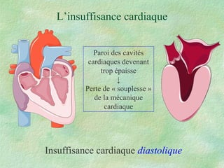 L’insuffisance cardiaque Insuffisance cardiaque  diastolique Paroi des cavités cardiaques devenant trop épaisse ↓ Perte de « souplesse » de la mécanique cardiaque 