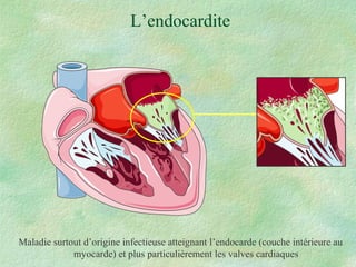 L’endocardite Maladie surtout d’origine infectieuse atteignant l’endocarde (couche intérieure au myocarde) et plus particulièrement les valves cardiaques  