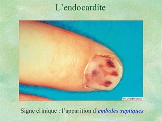 L’endocardite Signe clinique : l’apparition d’ emboles septiques 