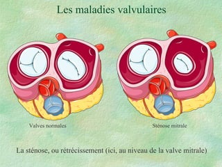 Les maladies valvulaires La sténose, ou rétrécissement (ici, au niveau de la valve mitrale) Valves normales Sténose mitrale 