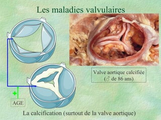 Les maladies valvulaires La calcification (surtout de la valve aortique) Valve aortique calcifiée ( ♂  de 86 ans) AGE  