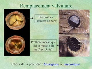 Remplacement valvulaire Choix de la prothèse :  biologique  ou  mécanique Bio prothèse (souvent de porc) Prothèse mécanique (ici le modèle dit de Saint-Jude ) 