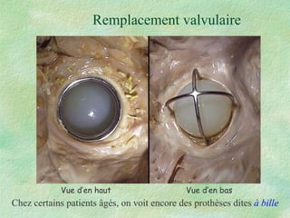 Remplacement valvulaire Chez certains patients âgés, on voit encore des prothèses dites  à bille Vue d’en haut  Vue d’en bas 