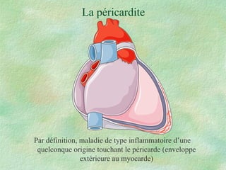 La péricardite Par définition, maladie de type inflammatoire d’une quelconque origine touchant le péricarde (enveloppe extérieure au myocarde) 