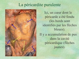 La péricardite purulente Ici, un cœur dont le péricarde a été fendu (les bords sont identifiés par les flèches bleues). Il y a accumulation de pus dans la cavité péricardique (flèches jaunes). 