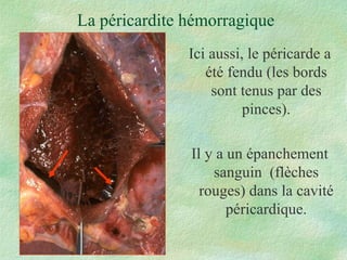 La péricardite hémorragique Ici aussi, le péricarde a été fendu (les bords sont tenus par des pinces). Il y a un épanchement sanguin  (flèches rouges) dans la cavité péricardique. 
