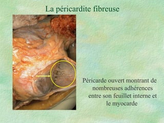 La péricardite fibreuse Péricarde ouvert montrant de nombreuses adhérences entre son feuillet interne et le myocarde  