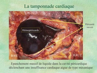 La tamponnade cardiaque Epanchement massif de liquide dans la cavité péricardique déclenchant une insuffisance cardiaque aigue de type mécanique Péricarde ouvert HAUT BAS Hémopéricarde 