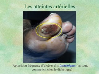 Les atteintes artérielles Apparition fréquente d’ulcères dits  ischémiques  (surtout, comme ici, chez le diabétique) 