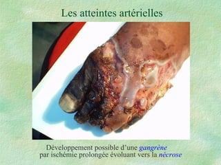 Les atteintes artérielles Développement possible d’une  gangrène par ischémie prolongée évoluant vers la  nécrose 