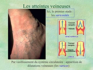 Les atteintes veineuses Par vieillissement du système circulatoire : apparition de dilatations veineuses (les  varices ) Ici, le premier stade : les  varicosités 