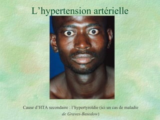 L’hypertension artérielle Cause d’HTA secondaire : l’hypertyroïdie (ici un cas de maladie de Graves-Basedow ) 