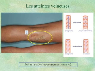 Les atteintes veineuses Ici, un stade (moyennement) avancé 
