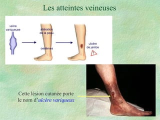 Les atteintes veineuses Cette lésion cutanée porte le nom d’ ulcère variqueux 