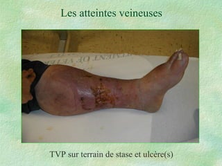 Les atteintes veineuses TVP sur terrain de stase et ulcère(s) 