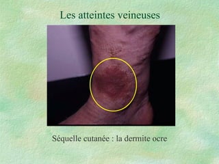 Les atteintes veineuses Séquelle cutanée : la dermite ocre 