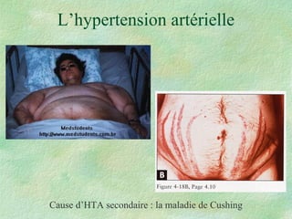 L’hypertension artérielle Cause d’HTA secondaire : la maladie de Cushing 