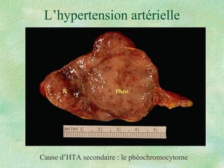 L’hypertension artérielle Cause d’HTA secondaire : le phéochromocytome N Phéo 