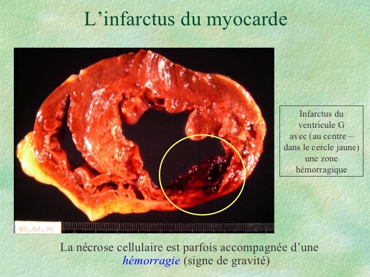 Peut On Vivre Avec Un Coeur Necrose