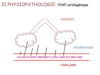 CAPILLAIRE
ALVEOLES
INTERSTITIUM
II PHYSIOPATHOLOGIE: l’OAP cardiogénique
AUGMENTATION PRESSION CAPILLAIRE PULMONAIRE
 