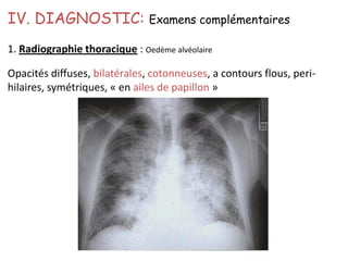 1. Radiographie thoracique : Oedème alvéolaire
Opacités diffuses, bilatérales, cotonneuses, a contours flous, peri-
hilaires, symétriques, « en ailes de papillon »
IV. DIAGNOSTIC: Examens complémentaires
 
