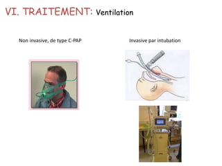 VI. TRAITEMENT: Ventilation
Invasive par intubation
Non invasive, de type C-PAP
 