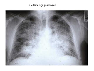 Oedeme aigu pulmonaire
 