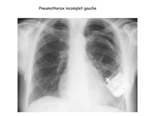Pneumothorax incomplet gauche
 