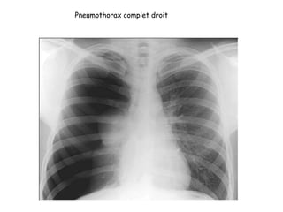Pneumothorax complet droit
 