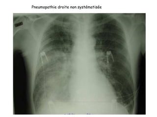 Pneumopathie droite non systématisée
 