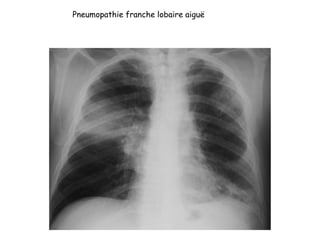 Pneumopathie franche lobaire aiguë
 