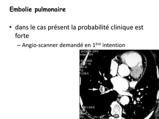 • dans le cas présent la probabilité clinique est
forte
– Angio-scanner demandé en 1ère intention
Embolie pulmonaire
 