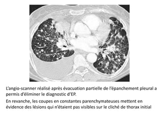 L’angio-scanner réalisé après évacuation partielle de l’épanchement pleural a
permis d’éliminer le diagnostic d’EP.
En revanche, les coupes en constantes parenchymateuses mettent en
évidence des lésions qui n’étaient pas visibles sur le cliché de thorax initial
 