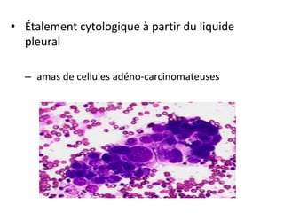 • Étalement cytologique à partir du liquide
pleural
– amas de cellules adéno-carcinomateuses
 