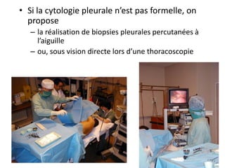 • Si la cytologie pleurale n’est pas formelle, on
propose
– la réalisation de biopsies pleurales percutanées à
l’aiguille
– ou, sous vision directe lors d’une thoracoscopie
 