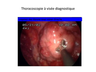 Thoracoscopie à visée diagnostique
biopsies des lésions sous vision directe
 