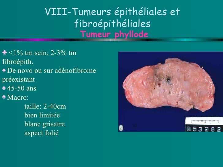 Pathologie BéNigne Du Sein