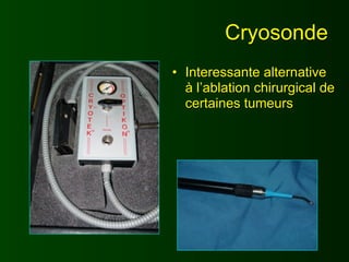 Cryosonde
• Interessante alternative
  à l’ablation chirurgical de
  certaines tumeurs
 