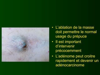• L’ablation de la masse
  doit permettre le normal
  usage du prépuce
• Il est important
  d’intervenir
  précocemment
• L’adénome peut croitre
  rapidement et devenir un
  adénocarcinome
 